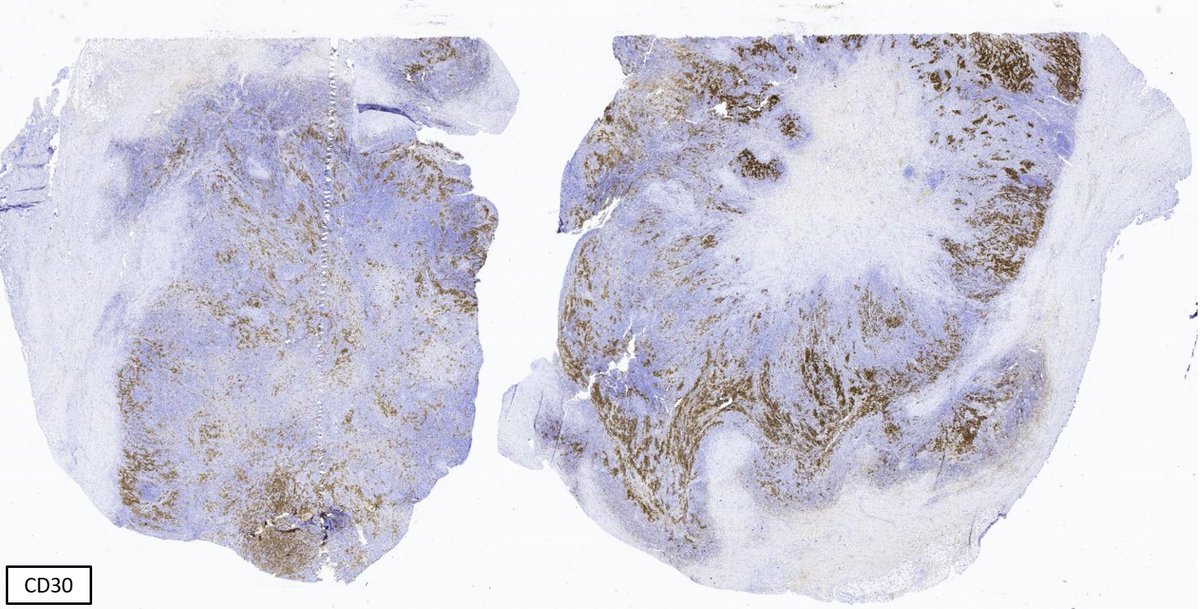 SibaElHussein's tweet photo. Mediastinal grey zone lymphoma, classic Hodgkin lymphoma-like:
🩸Confluent pleomorphic cells admixed with eosinophils &amp; dense fibrotic stroma 
🩸Uniform strong expression of CD20, PAX5 &amp; at least one additional B marker (CD19, CD79a, BOB1, OCT2)  
🩸CD30+

#hemepath #lymsm https://t.co/7yngjLUESw