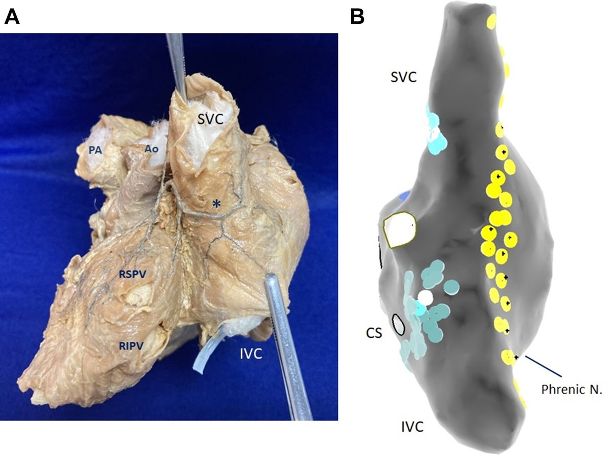 Sinus node artery occlusion is a rare #complication of cardiac neuroablation procedures. In this issue of #JACCCaseReports, experts discuss how to avoid this adverse event: bit.ly/3E0zSz2

#Cardiology #cvEP #CardioEd #CardioTwitter