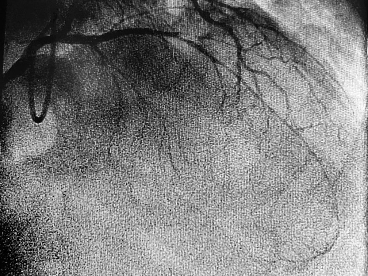 Coronary vasospasm testing is here! First in Oregon @ProvHealth #CardioTwitter @InocaInternati1 Completes triad of comprehensive testing of chest pain: 1. Angio ➡️ major vessel blockages 2. Flow wire ➡️ microvascular blockages 3. Acetylcholine ➡️ vasospasm Before & after ACh: