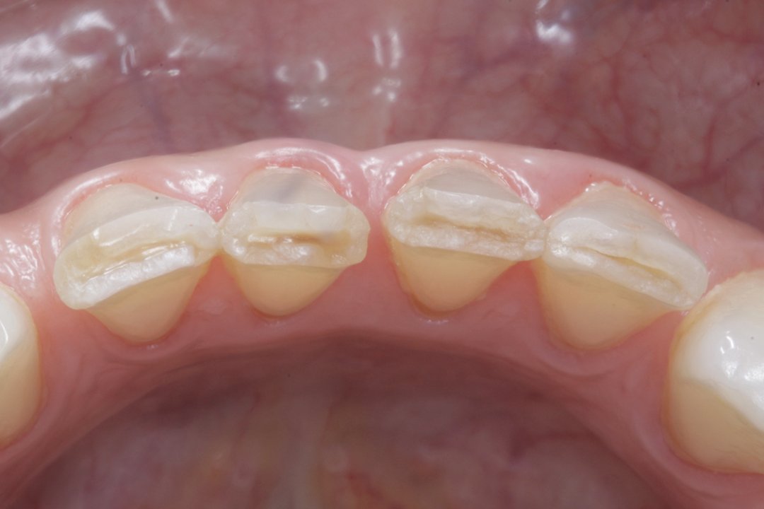Cuando alguien pierde los dientes de la zona posterior, empieza a masticar con los de la zona anterior. Como estos no están diseñados para triturar alimentos, experimentan un envejecimiento prematuro y deterioro acelerado (en este caso los bordes se han desgastado y fracturado).
