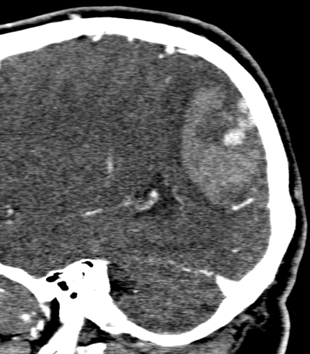 1. 
Medical H: 64y.o Headache, visual disturbance, and instability.
Ph Exam: GCS 15 and cuadrantanopia.
CT+angioCT: left inferior parietal hematoma  + small AVM (SM 1)

<a href="/FuatArikan/">Fuat Arikan</a> <a href="/vallhebron/">Vall d'Hebron</a>