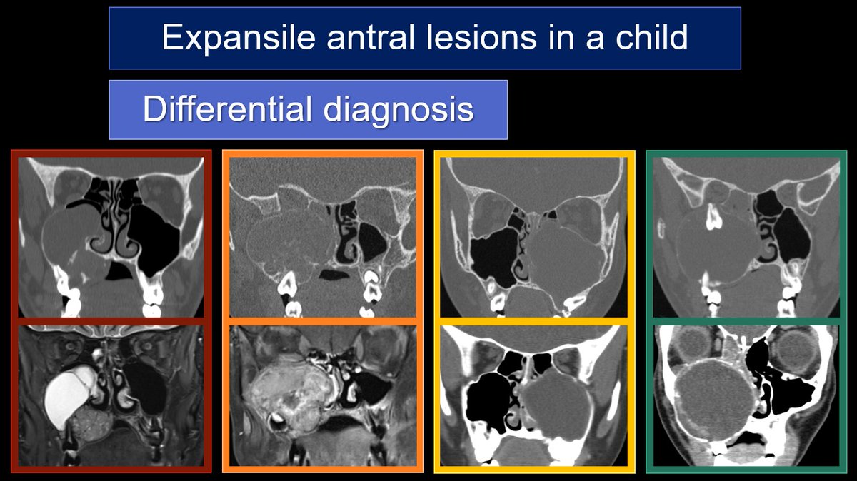 Week 3: DDx P(a)ed expansile lesions involving the maxillary antrum. ⭐️Odontogenic vs non-odontogenic ⭐️Solid vs cystic vs both? ⭐️Any mineralization? ⭐️Benign vs locally aggressive vs malignant? #FOAMrad #FOAMed #MedEd #NeuroRad