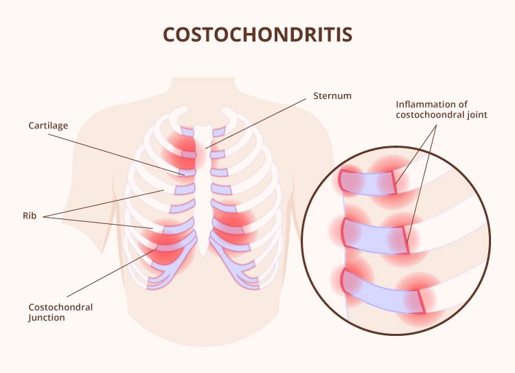 Chest pain! It can be so scary. Costochondritis is a condition which cause inflammation of the junction where the upper ribs join with the cartilage that holds them to the breastbone or sternum. The condition causes localized chest wall pain and tenderness that can be reproduced