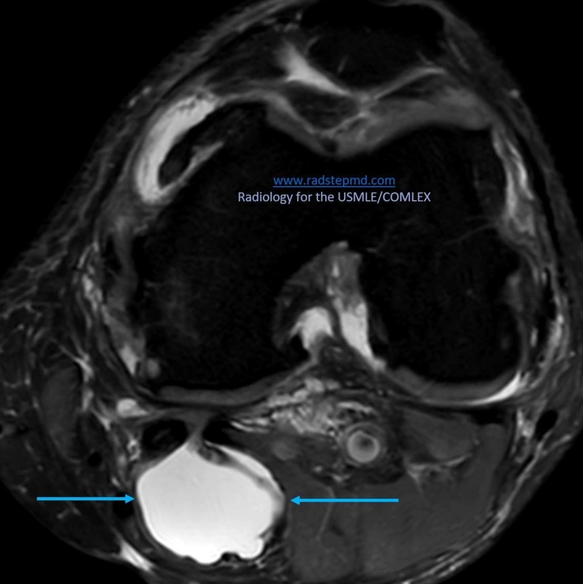 RadStepMD's tweet image. Todays images look at BAKER’S CYST

radstepmd.com

IMAGING:
Collection of synovial fluid in the gastrocnemius-semimembranosus bursa

USMLE POINTS:
Posterior knee stiffness 
May form in the setting of chronic degenerative or inflammatory joint disease