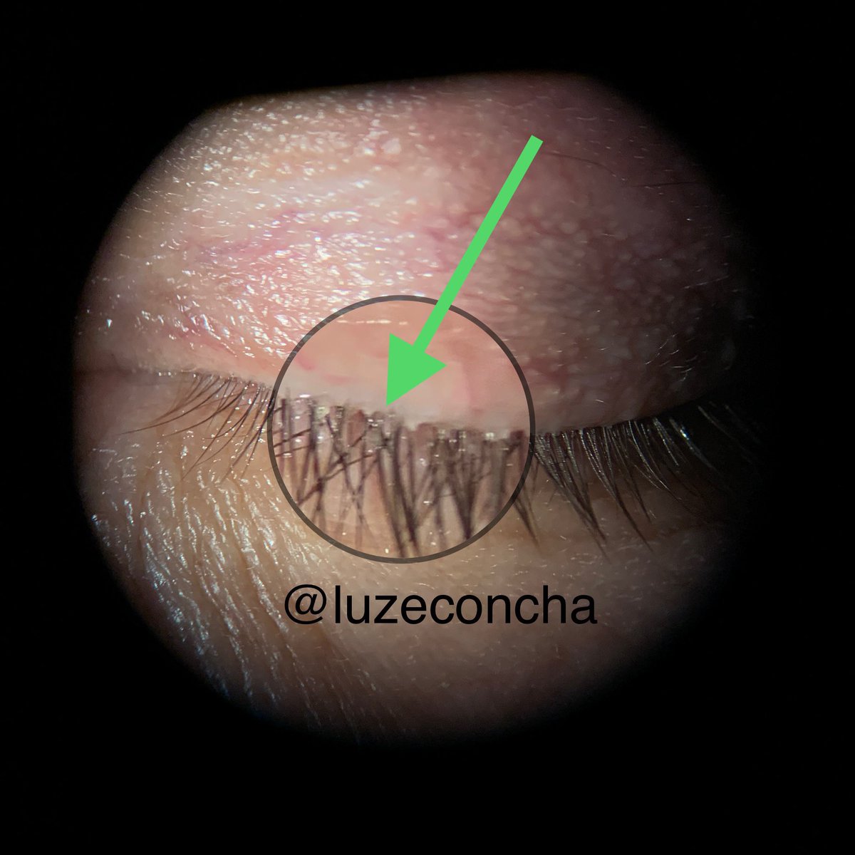 LuzEConcha's tweet photo. El Demodex es un ácaro que vive en los folículos pilosos humanos, generalmente en la cara. 
Afecta el margen del párpado y la superficie ocular.
👁️👁️Sensación de quemarse o basura,
picazón, ojo rojo, escamas en pestañas.
#demodex #ojorojo #saludvisual https://t.co/kEutXQW52e