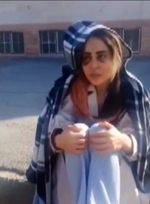 shimababaeii's tweet photo. این تصویر #مینا_یعقوبی دختر انقلابی ماست.
او را به حدی شکنجه کردند که در زمان آزادی موقت چشمانش کبود و سرش شکسته بود.
اما ج.ا این شکنجه‌ها را برای او که فریاد زده بود «زن زندگی آزادی» کافی ندید.
مینا به ۱۱سال حبس تعزیری، ۱۲۴ساعت قبرشویی، تحمل ۸۵ ضربه شلاق و ۲سال تبعید محکوم شده. https://t.co/4YIpX2k5jt