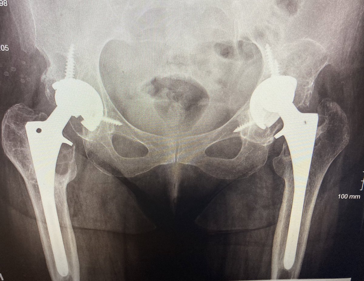 Ricky Singh, MD (@tarheel1991) on Twitter photo Hi #orthotwitter need some help identifying the implants. Done 20+ years ago in DR. Cup S&N Reflection? Stem ZB? <a href="/aschwartz45/">Andy Schwartz</a> <a href="/jointdocShields/">John Shields, MD, FAAOS</a> <a href="/CenterRotation/">Brock Howell MD, FAAOS</a> <a href="/generalorthomd/">Very General Orthopaedist</a> Hi #orthotwitter need some help identifying the implants. Done 20+ years ago in DR. Cup S&N Reflection? Stem ZB? <a href="/aschwartz45/">Andy Schwartz</a> <a href="/jointdocShields/">John Shields, MD, FAAOS</a> <a href="/CenterRotation/">Brock Howell MD, FAAOS</a> <a href="/generalorthomd/">Very General Orthopaedist</a>