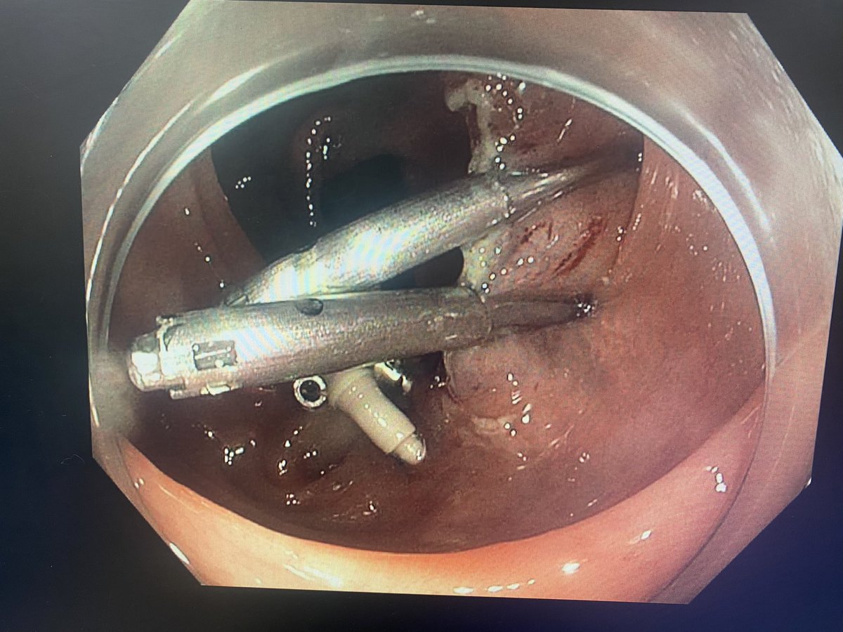 Excellent start of the week @ SUNY Upstate. ESD of a Paris IIa+IIc Descending colon polyp to ensure En Bloc resection and zipper closure using X tack and 2 endoclips.