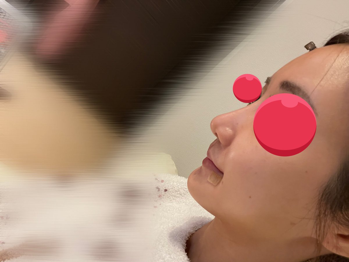 3ヶ月目忘れてたので上げ直し✏️

チョンダム美容外科 ビフォアフ

鼻フル
(プロテーゼ＋鼻先＋鼻中隔延長＋小鼻縮小＋骨切り幅寄せ)
外側人中＋口角挙上

1枚目ビフォー
2枚目1ヶ月目 ノーメイク
3枚目 2ヶ月目 メイク有
4枚目3ヶ月目 ノーメイク
(照明と角度ズレてます)