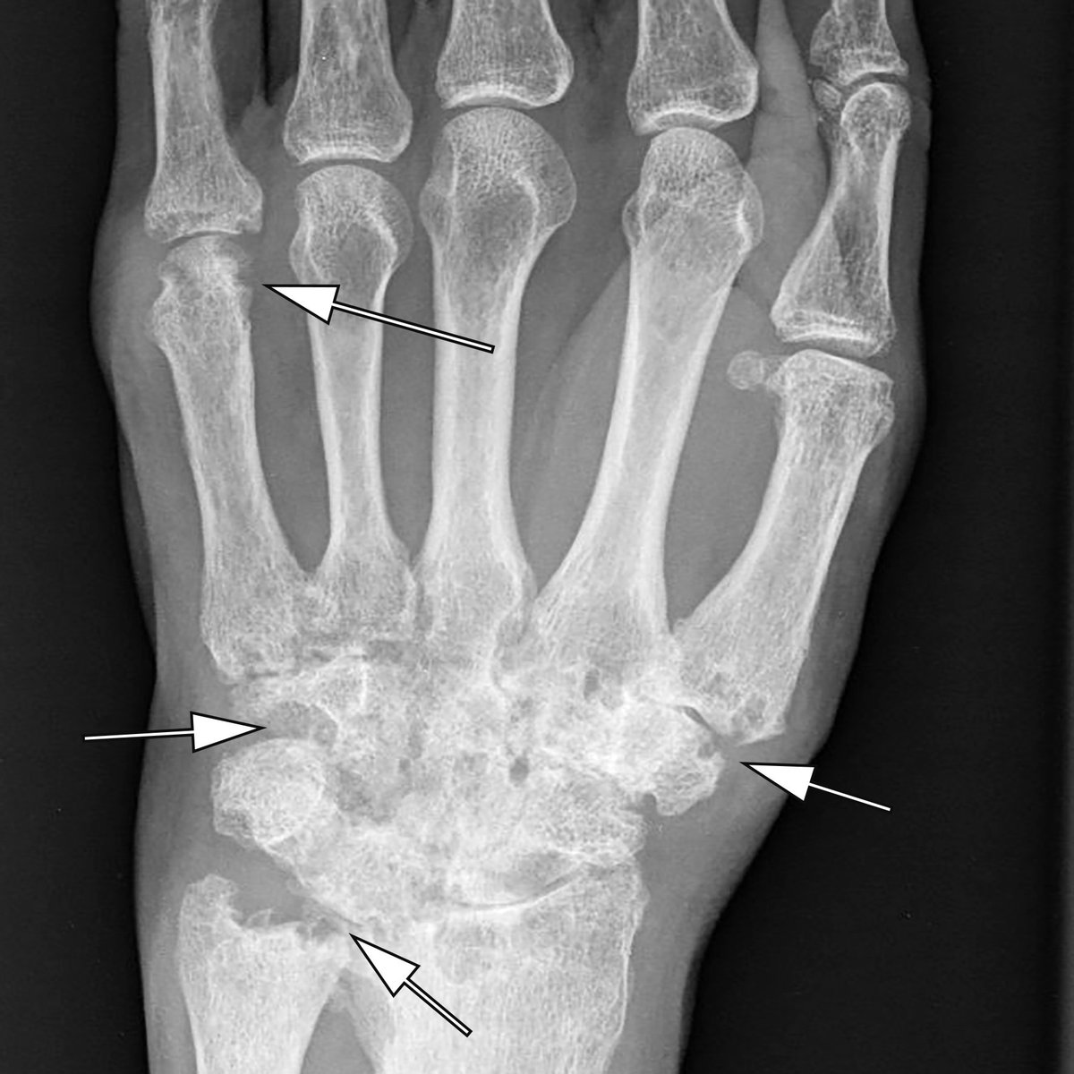 Hand radiographs obtained on the same day show severe signs of rheumatic disease with multiple bone erosions (arrows). Thus, knee findings are a result of secondary post-arthritic OA characterized by large erosive lesions also at the knee, not typical for primary OA.
