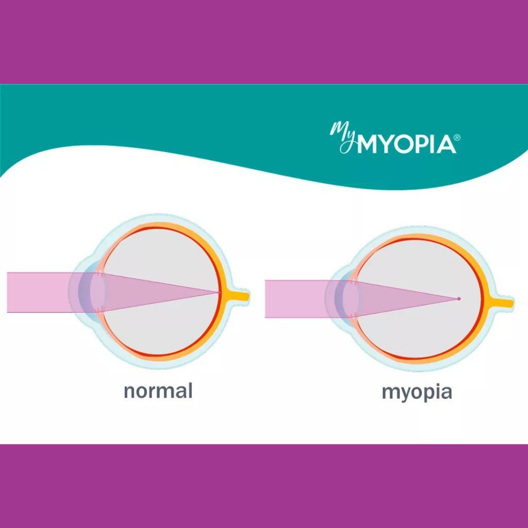 In the coming weeks, we will be sharing frequently asked questions from parents to help you learn more about myopia (nearsightedness). Today's question: what causes myopia?