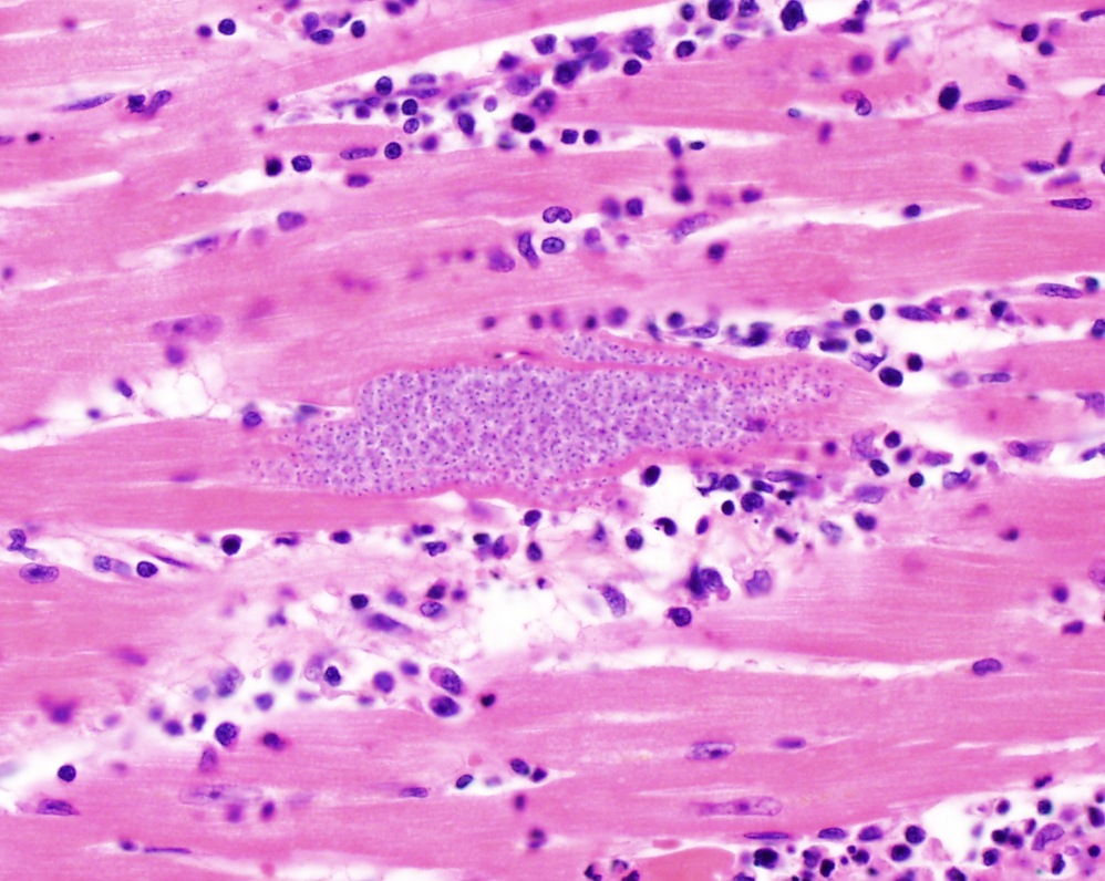 ParasiteGal's tweet image. Here’s a special Valentine’s day case on matters of the heart – inspired by @MeredithKHerman: parasitewonders.blogspot.com/2023/02/case-o…  Answer later this week. #mayopath #pathology #IDPath #CrittersOnTwitter #PathBugs