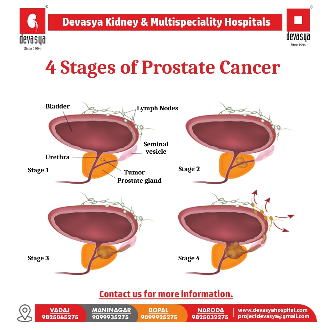 KidneyHospital's tweet photo. There are total four types of stages. Do you want to know more details about the four stages of treatment for this deadly disease?  We will discuss it in our future posts, so stay tuned. For mor information give us a call.

Visit our website : https://t.co/sDMGKW2w9e https://t.co/OT41d9vFG7