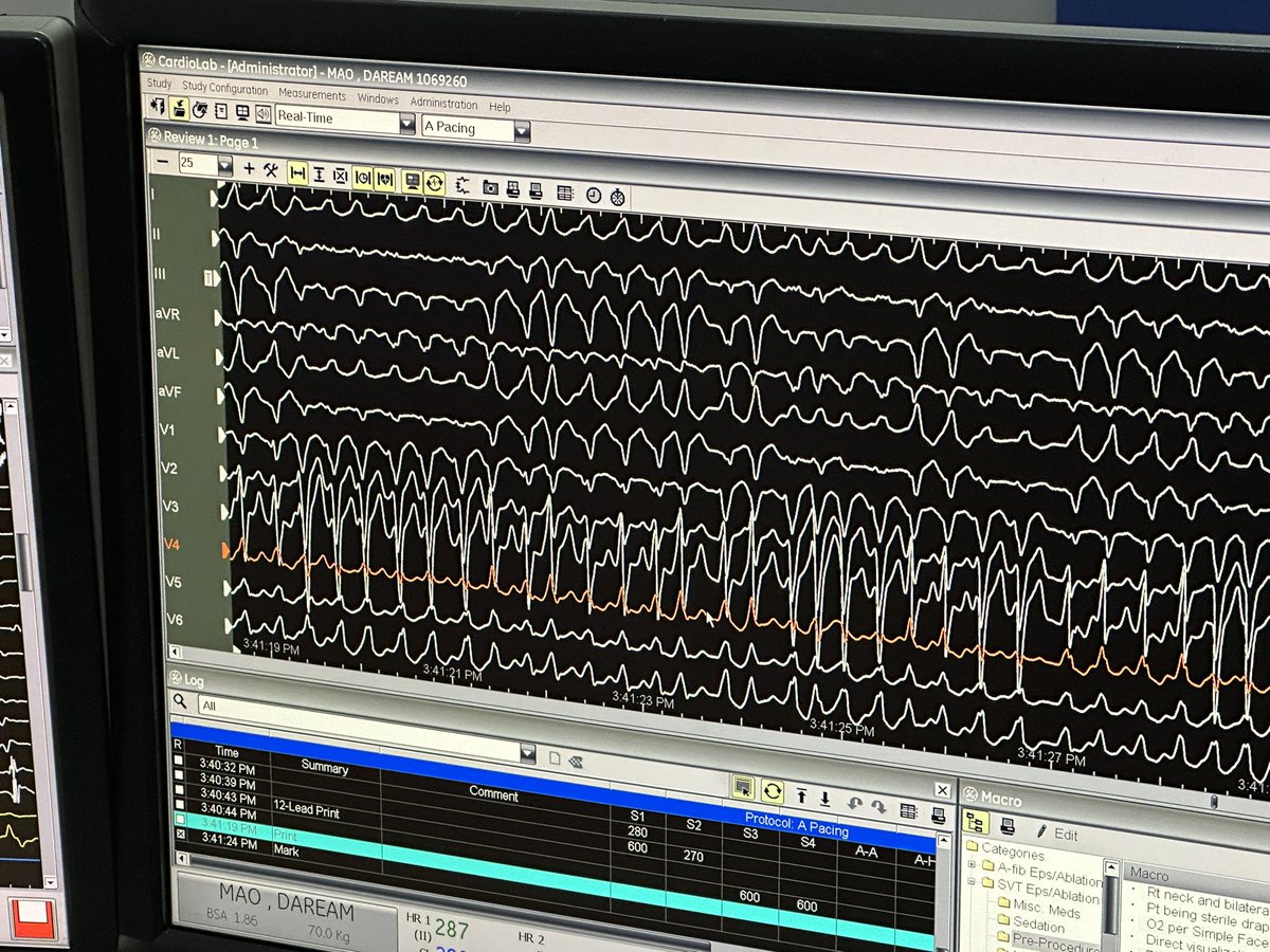 Sri Sundaram (@srissundaram) on Twitter photo <a href="/Tomytachycardia/">Thomas Rogers</a> and <a href="/MarcLahiriEP/">Marc Lahiri, MD</a> helping <a href="/pichmanil/">Pichmanil Khmao</a> with rapid WPW in Cambodia. Another good day with our medical mission. <a href="/AbbottCardio/">Abbott Cardiovascular</a> <a href="/AndrewKrahnMD/">Andrew Krahn</a> <a href="/APHRSOfficial/">APHRS Official</a> <a href="/Tomytachycardia/">Thomas Rogers</a> and <a href="/MarcLahiriEP/">Marc Lahiri, MD</a> helping <a href="/pichmanil/">Pichmanil Khmao</a> with rapid WPW in Cambodia. Another good day with our medical mission. <a href="/AbbottCardio/">Abbott Cardiovascular</a> <a href="/AndrewKrahnMD/">Andrew Krahn</a> <a href="/APHRSOfficial/">APHRS Official</a>