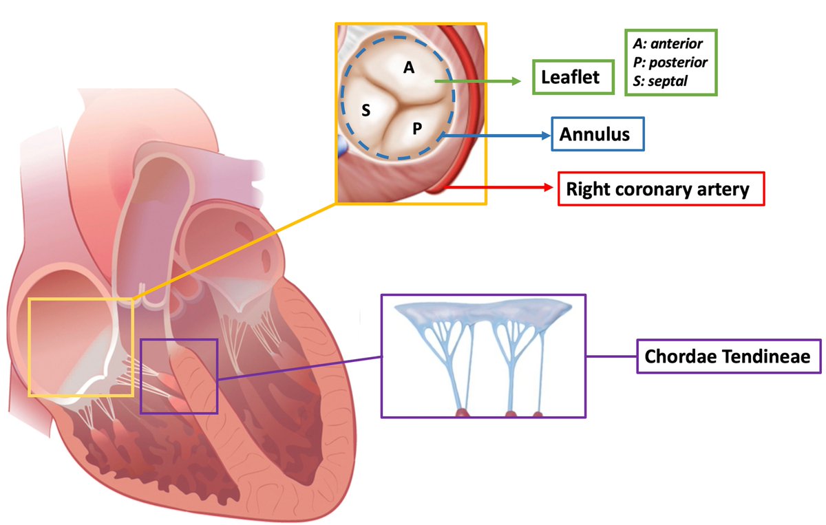 RCMjournal's tweet image. #RCM-Special Issue: Present and future of #tricuspid #regurgitation (5/5)

🍀Percutaneous Tricuspid Valve Repair
 @AntonioMangieri @Sticchi_Alex @DamianoRegazzo1 @FabioFazzari2 @BeniaminoPagli1 @ChiaritoMauro @FabienPraz @azeemlatib @Antocol17

Full Text
imrpress.com/journal/RCM/23…