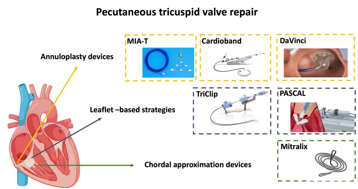 RCMjournal's tweet image. #RCM-Special Issue: Present and future of #tricuspid #regurgitation (5/5)

🍀Percutaneous Tricuspid Valve Repair
 @AntonioMangieri @Sticchi_Alex @DamianoRegazzo1 @FabioFazzari2 @BeniaminoPagli1 @ChiaritoMauro @FabienPraz @azeemlatib @Antocol17

Full Text
imrpress.com/journal/RCM/23…