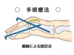 Bertolt_TDA's tweet photo. 薬指の骨性マレットの手術した方がいいよとお医者さんに言われましたが手術方法聞いて辞めました。
今回は装具にて治療します。 https://t.co/rfPrJ6aowt