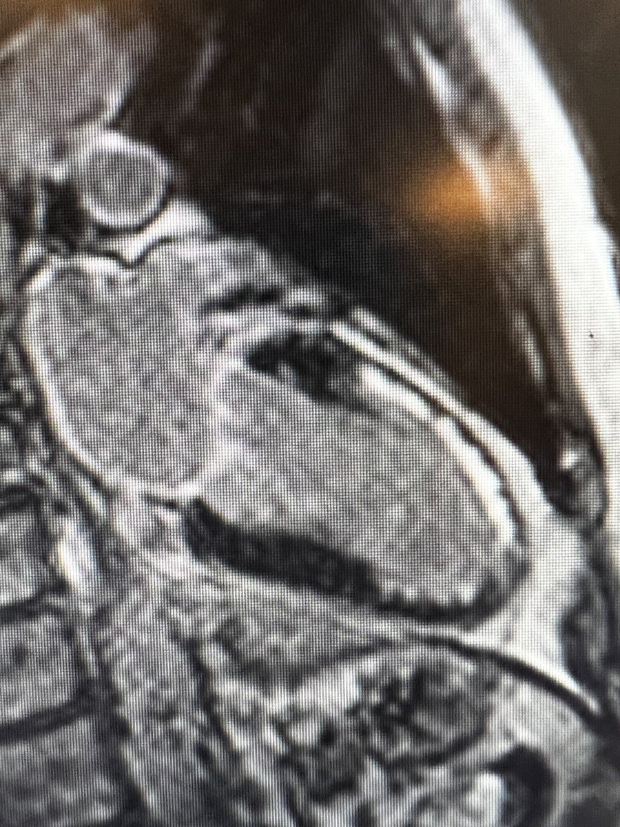 After just 3 months, 214 patients have been included in the PULSE-MI trial! Today, the fifth patient will undergo the 3 month follow-up CMR to evaluate final infarct size 🫀 @rigsheart #RCT