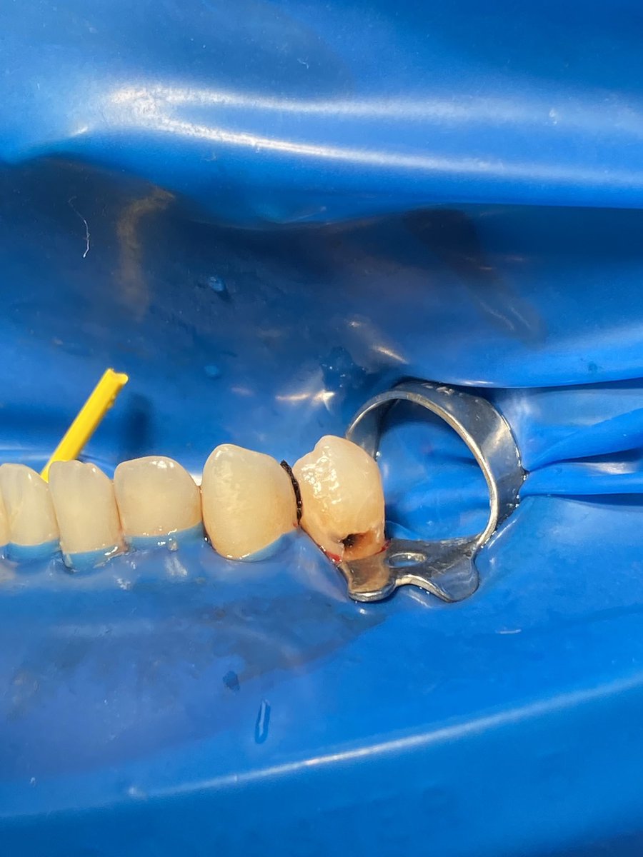 alotaibisnajd's tweet photo. First class V composite restoration was done on tooth #21 https://t.co/z62fRyiy3Z