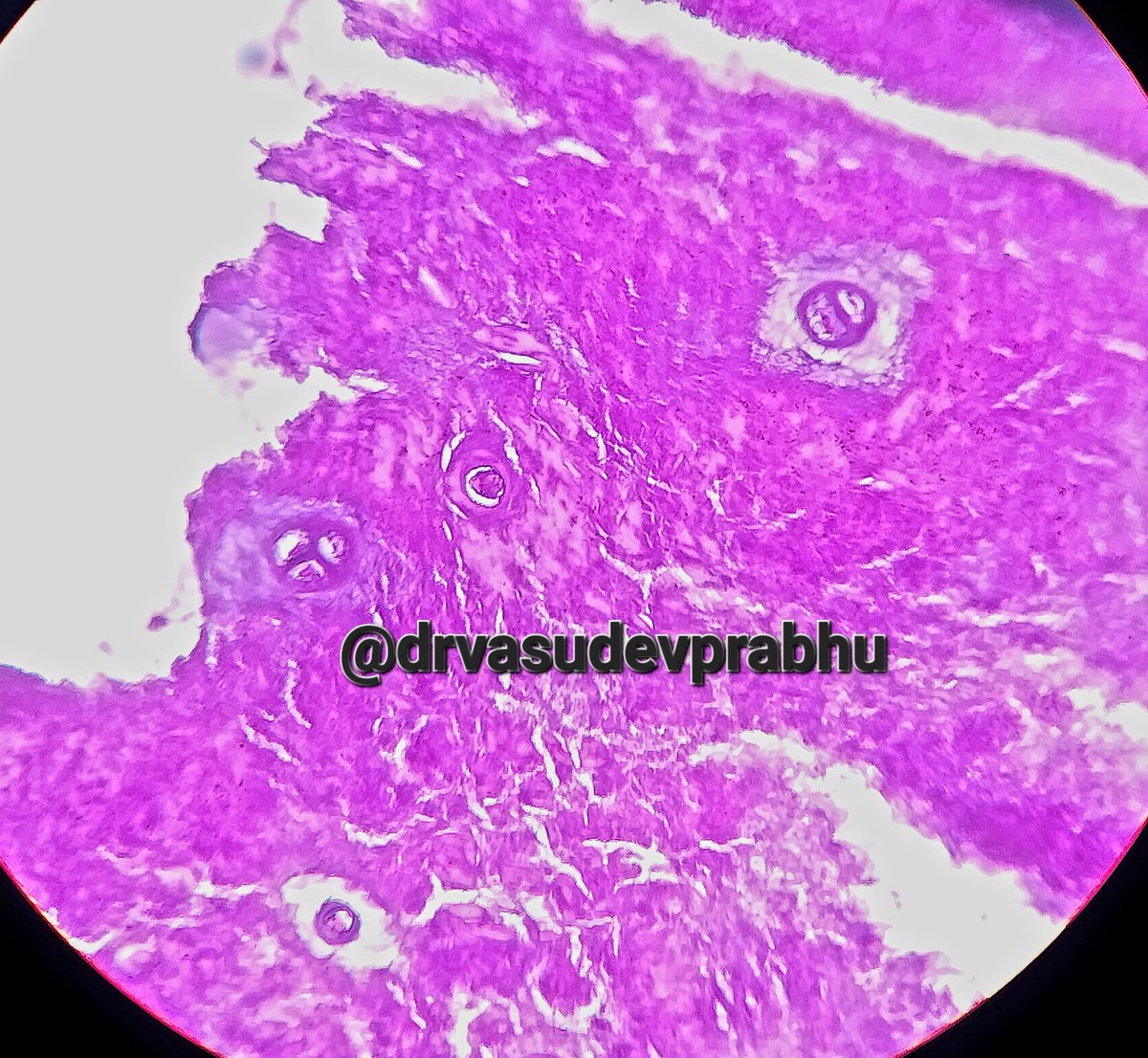 DrVasudevPrabhu's tweet photo. Those Rounded structures... What are we looking at 🤔👀 #pathologyresidents #medtwitter #PathTwitter #pathology #pathboards #pathspotters #pathologyresident @RagaviRamanan @RizviUroos @premcharles @padmapathology1 @shalinirkr21 https://t.co/HmtyVIdxHM