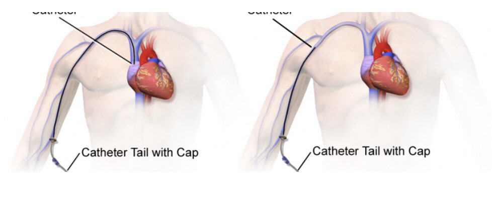 Los pacientes portadores de midline pueden experimentar menos CRBSI que aquellos que usan PICC.  Sin embargo, el uso de midline se asocia con un mayor riesgo de trombosis venosa superficial.  Si, no? Que dice la evidencia?  
academic.oup.com/ofid/article/1…