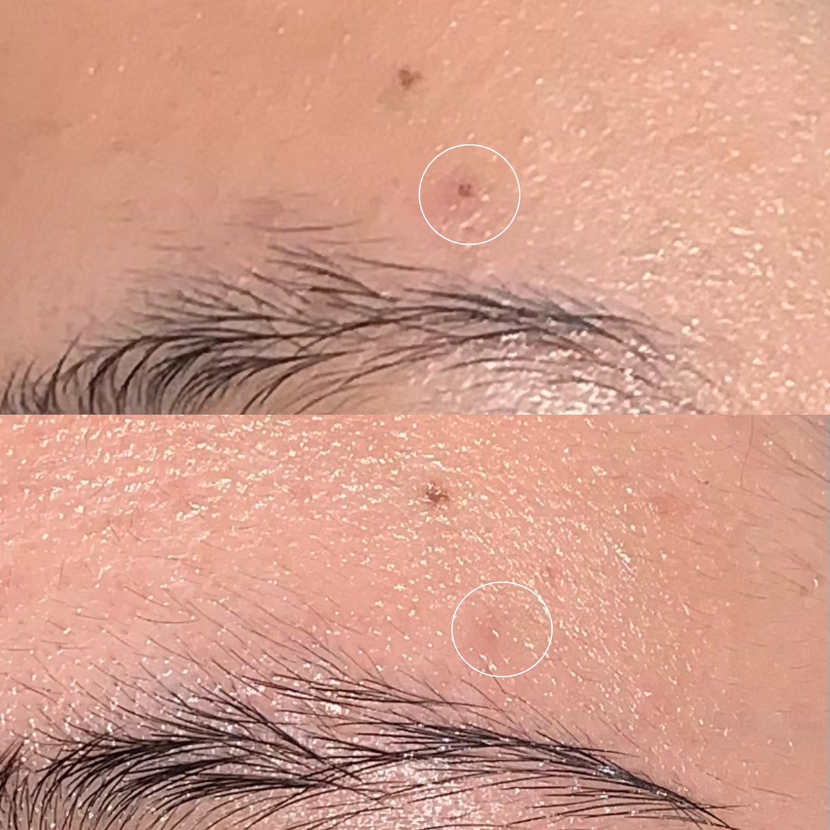 oilbebetter's tweet photo. kadang suka sebel punya darah manis alias sering banget digigitin nyamuk even di area muka pun iya😩

ALHAMDULILLAH untung ternyata ada moisturizer yang bisa ngeredain gatel, merah2 setelah digigit nyamuk dalam semalaman. kenapa baru tau sekarang😭
#racuninskincare https://t.co/KMLVKDfGVW
