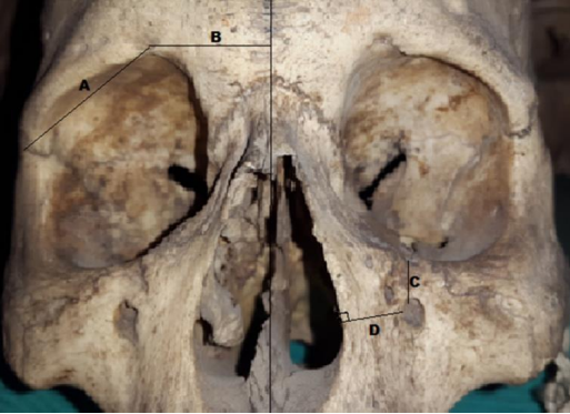 ijmrhs's tweet photo. 😍I'm glad to share a paper from Prof. Roberto Chavez Asmat who comes from the National University of San Marcos, Peru
Title 💬 : #Morphometric Study of #Orbitary and #Periorbitary Region in Peruvian #Skulls: Importance to #Surgical Approach
Read more 🔍: https://t.co/wp33IcgcL5 https://t.co/GLoVxqTfkt