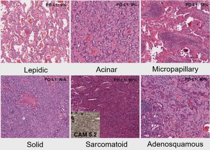 JMP_MDPI's tweet photo. 📢New published paper ''#MET Exon 14 Variants in Non-Small Cell #Lung Carcinoma: Prevalence, #Clinicopathologic and #Molecular Features''
📌Enjoy reading: https://t.co/BVUHvqrbxx
#exon14; #non_small_cell_lung_carcinoma #NSCLC https://t.co/cpBqPOMzhC