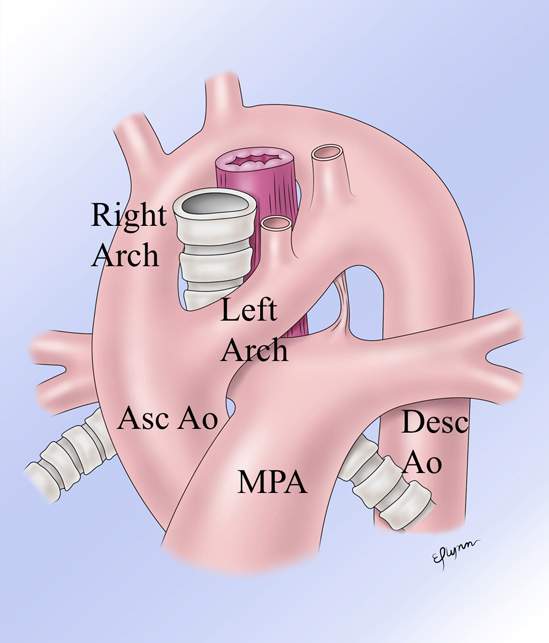 OPENPediatrics's tweet photo. The arches encircle the posterior esophagus and anterior trachea. The ligamentum arteriosum joins the left arch to the pulmonary artery. You can see more in the Vascular Ring section of Geggel's #CHD Library. https://t.co/jtzqaXTOYm #CardiacED
2/2 https://t.co/ABadO3s1za