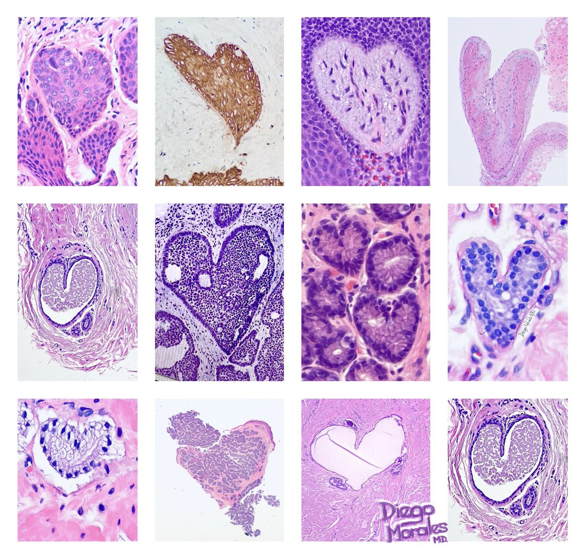 DiegoMoralesN's tweet photo. When “Tabitha” (your microscope) shows its ‘love’ back.
#PathTwitter Happy Tuesday and Happy Valentine’s day.
#pathfulness #ILookLikeAPathologist #pathart #JoyForMorphology #FreudeAnDerMorphologie #tooprettynottoshare https://t.co/cSdargJhlF