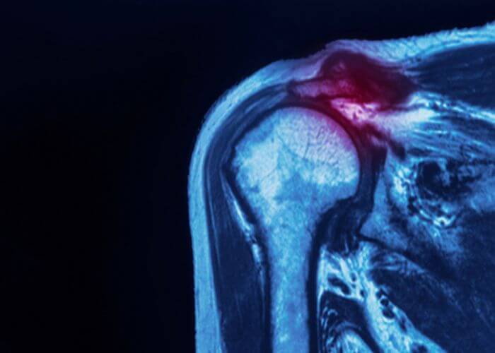 rileywilliamsMD's tweet photo. What is a #SLAPtear in the #shoulder?
The population most at risk of a SLAP tear are athletes that perform repetitive overhead motions like those in baseball, tennis & weightlifting. However, a SLAP tear can also occur as a result of a #tramauticinjury...https://t.co/PmQxverHum https://t.co/KKFFtReqKz