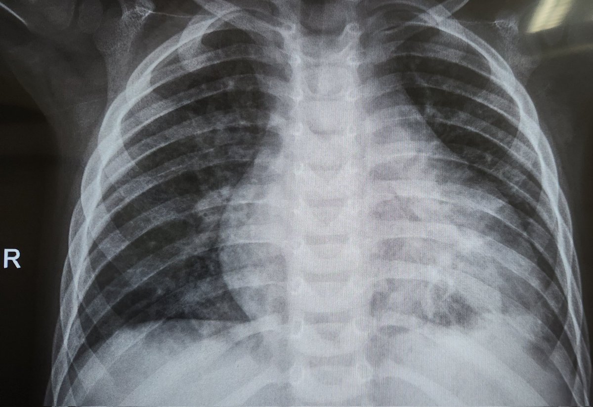 swatigar's tweet photo. 1/9 Congenital mitral valve disease....one of the most frustrating diseases.
For pt family obviously. But also for peds card team. .
To have to repair in infancy is challenging at the very least. 
Check this case out. 
A toddler weighing under 10kg.
Severe mitral stenosis. https://t.co/dw3AUF6J6o