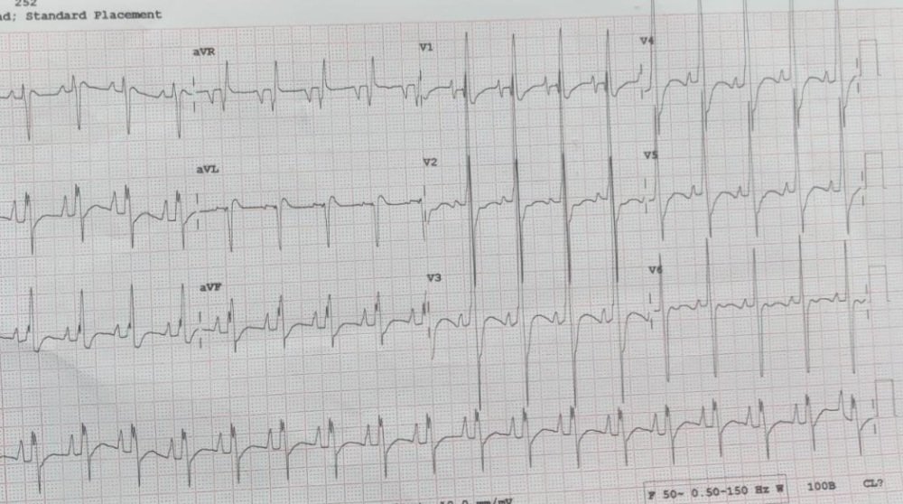 1/9 Congenital mitral valve disease....one of the most frustrating diseases.
For pt family obviously. But also for peds card team. .
To have to repair in infancy is challenging at the very least. 
Check this case out. 
A toddler weighing under 10kg.
Severe mitral stenosis.