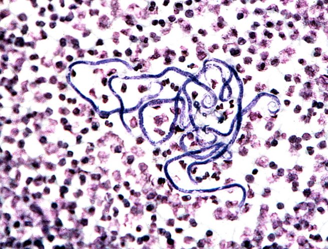 NicoGagelmann's tweet photo. 25 year old from Nigeria presented with generalized itching, diffuse swelling esp axillar and cervical lymph nodes and fatigue.
Auscultation 🫁 suggests effusion
🩸anemia but rest ok

Smear shows 👇

Differential?
Diagnosis?
Treatment?

#MedTwitter https://t.co/a5ZLDRRt56