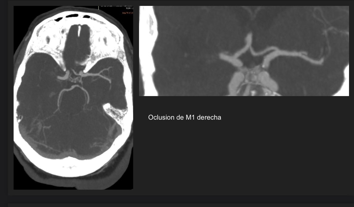 ELeNaZapS's tweet photo. #neurocase #stroke #mechanicalthrombectomy. 80yo female. Right M1 occlusion. NIHSS 15. ASPECTS 6. https://t.co/XocYCSuKg0
