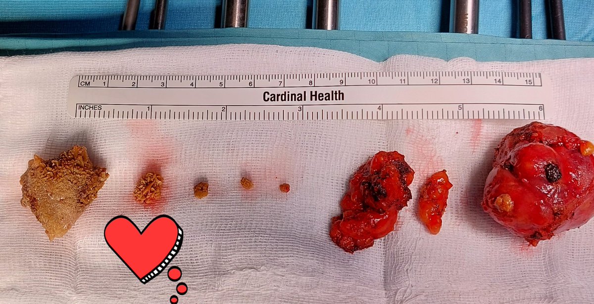 mauro_ragonese's tweet photo. Great surgery on St Valentine's day with @Dr Angelo Totaro and @Dr Eros Scarciglia....Robotic partial nephrectomy and pyelolitothomy with removal of a "heart" shaped stone in the renal pelvis.... https://t.co/rWw1vkDGWy