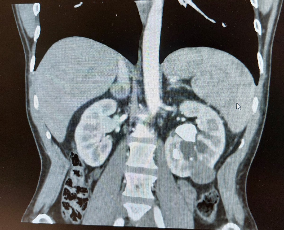 mauro_ragonese's tweet photo. Great surgery on St Valentine's day with @Dr Angelo Totaro and @Dr Eros Scarciglia....Robotic partial nephrectomy and pyelolitothomy with removal of a "heart" shaped stone in the renal pelvis.... https://t.co/rWw1vkDGWy