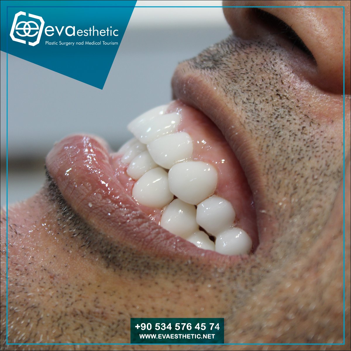 Eva Esthetic | Hollywood smile 🦷✅.
💯WhatsApp Dercet: (bit.ly/2T3QtuF) 🌏
Or through the following number: 00905345764574
🌏 evaesthetic.net
Book your appointment now ✈️