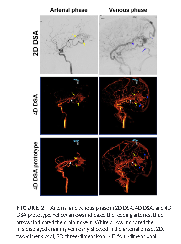 JNeuroimaging's tweet photo. 4D digital subtraction #angiography may complement 2D and 3D #neuroimaging for #cerebral #arteriovenous malformations for grade, feeders, draining veins and #intranidal #aneurysms #WeichuXiang #LiPan #neurology #neurosurgery #neurorad #radres https://t.co/Xj0SoiptfX https://t.co/aMhYV8B0m0