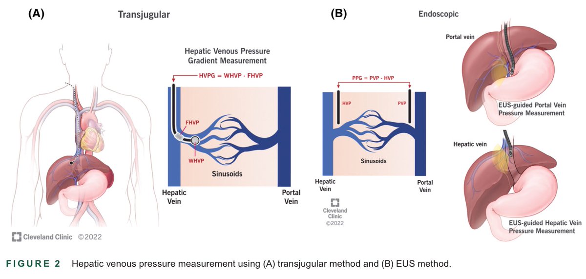 EUS & ERCP Master on Twitter "Endohepatology procedures"
