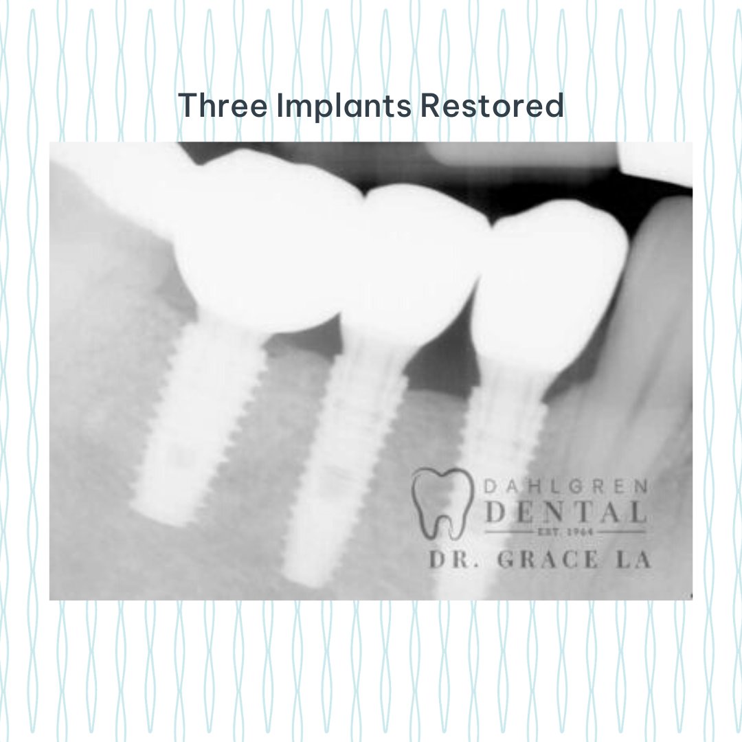 Dr. La's dental expertise + guided implant surgical technique = incredible results! 🤩

Learn more about guided implant surgery and the many advantages this technique offers by following the link below.
dahlgrendentalva.com/implant-dentis…

#GuidedImplantSurgery