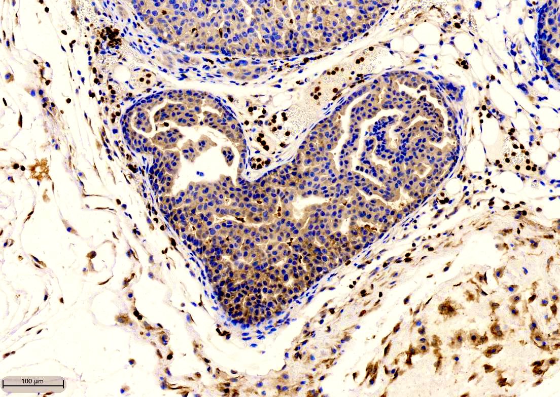 Happy St. Valentine’s Day! The image is of a heart-shaped human xenograft in situ mammary tumor. #DCIS #BreastCancer #ValentinesDay #breastcancerawareness