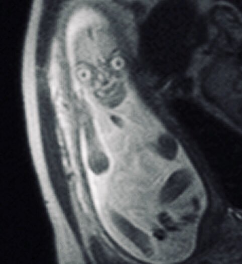 mri of a human fetus