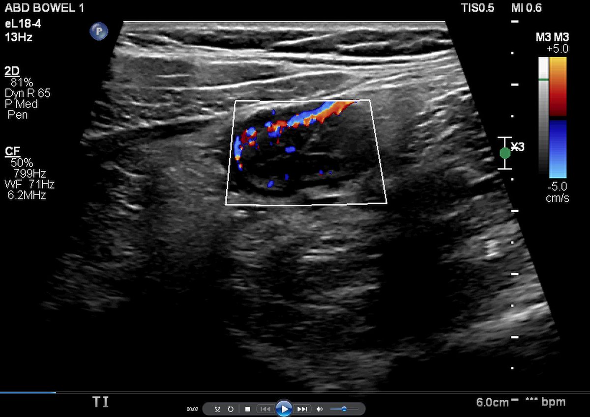 Baldeep Pabla, MD MSCI (@baldeeppablamd) on Twitter photo Hey <a href="/Cigna/">Cigna Healthcare</a> - this is what your inappropriate denial of infliximab means for my patient. Severe BWT of the neo-TI with a markedly increase doppler signal on bowel ultrasound = 🔥🤕suffering! Please answer our messages to restart therapy ASAP #FightWithUs Hey <a href="/Cigna/">Cigna Healthcare</a> - this is what your inappropriate denial of infliximab means for my patient. Severe BWT of the neo-TI with a markedly increase doppler signal on bowel ultrasound = 🔥🤕suffering! Please answer our messages to restart therapy ASAP #FightWithUs