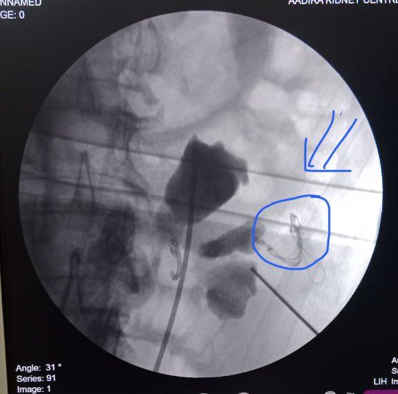 surgeonmukhil's tweet photo. Retained stent
Partially removed the stent- failed to place guide wire after puncturing , outer sheath of  guidewire got entrapped outside the kidney -referred to us @akaroune 

We did supinepcnl  middle calyx puncture
Retrieved the stent
During exit-guidewire removed completely. https://t.co/0qHi5LiZwK