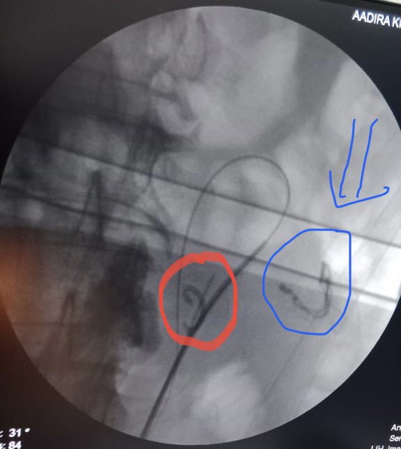 surgeonmukhil's tweet photo. Retained stent
Partially removed the stent- failed to place guide wire after puncturing , outer sheath of  guidewire got entrapped outside the kidney -referred to us @akaroune 

We did supinepcnl  middle calyx puncture
Retrieved the stent
During exit-guidewire removed completely. https://t.co/0qHi5LiZwK