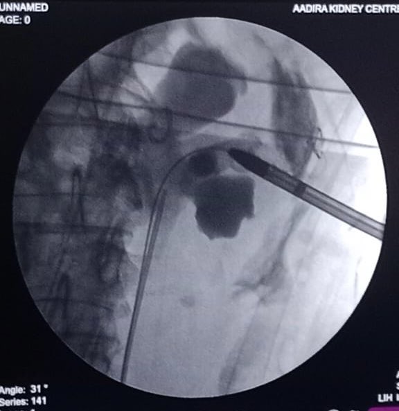 surgeonmukhil's tweet photo. Retained stent
Partially removed the stent- failed to place guide wire after puncturing , outer sheath of  guidewire got entrapped outside the kidney -referred to us @akaroune 

We did supinepcnl  middle calyx puncture
Retrieved the stent
During exit-guidewire removed completely. https://t.co/0qHi5LiZwK
