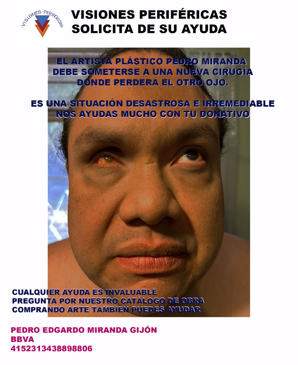 visionperiferia's tweet photo. Amigos compartimos nuevamente la invitación para apoyar a @GijonMiranda en esta situación tan catastrófica que es perder su segundo ojo en menos de tres meses. Cualquier ayuda será bien recibida @discapacidadcom @chuchougalde1 @Renac_MX @DirectoOaxaca @PulsoLegisOax @CUrbOax https://t.co/UXEaBmi2Fu