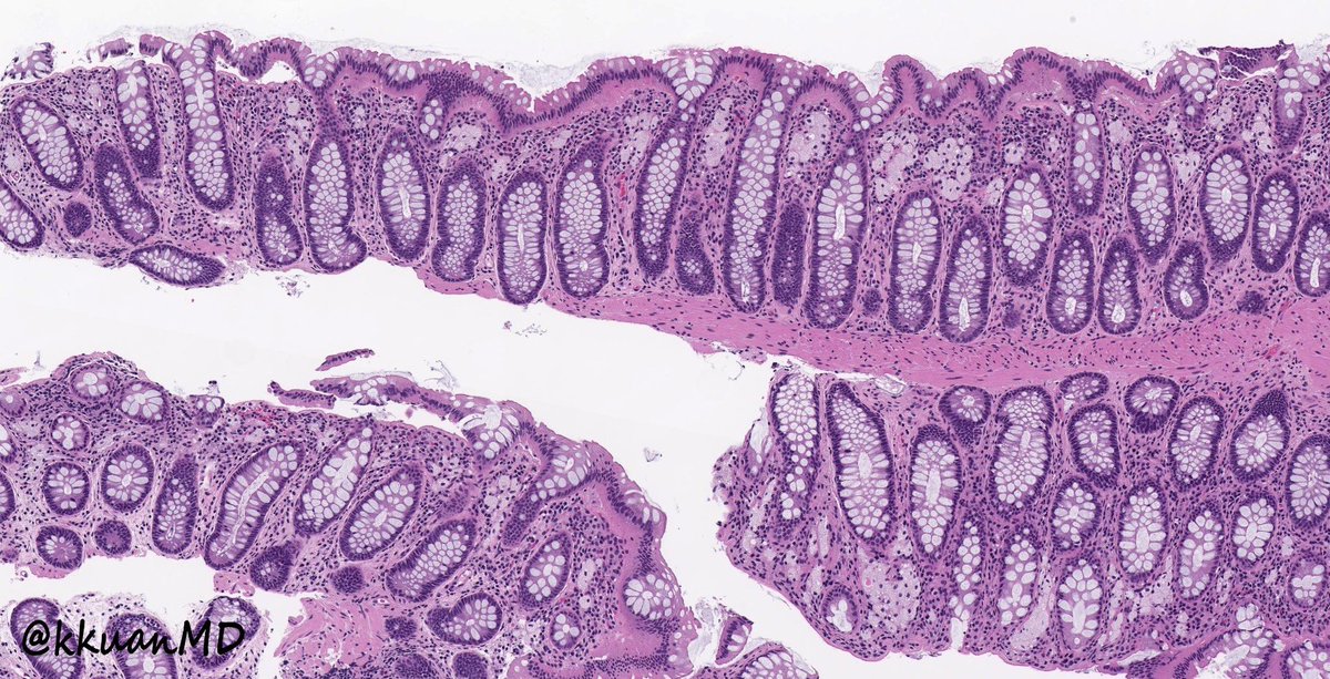 Rectal biopsy. #PathTwitter #GIpath  #pathresident #pathboards