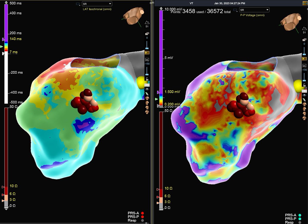 Hapa_EP's tweet image. What could have been a lengthy homogenization of a massive inferior scar now becomes just a handful of burns in a small, but critical zone for VT. #mapmoreburnless